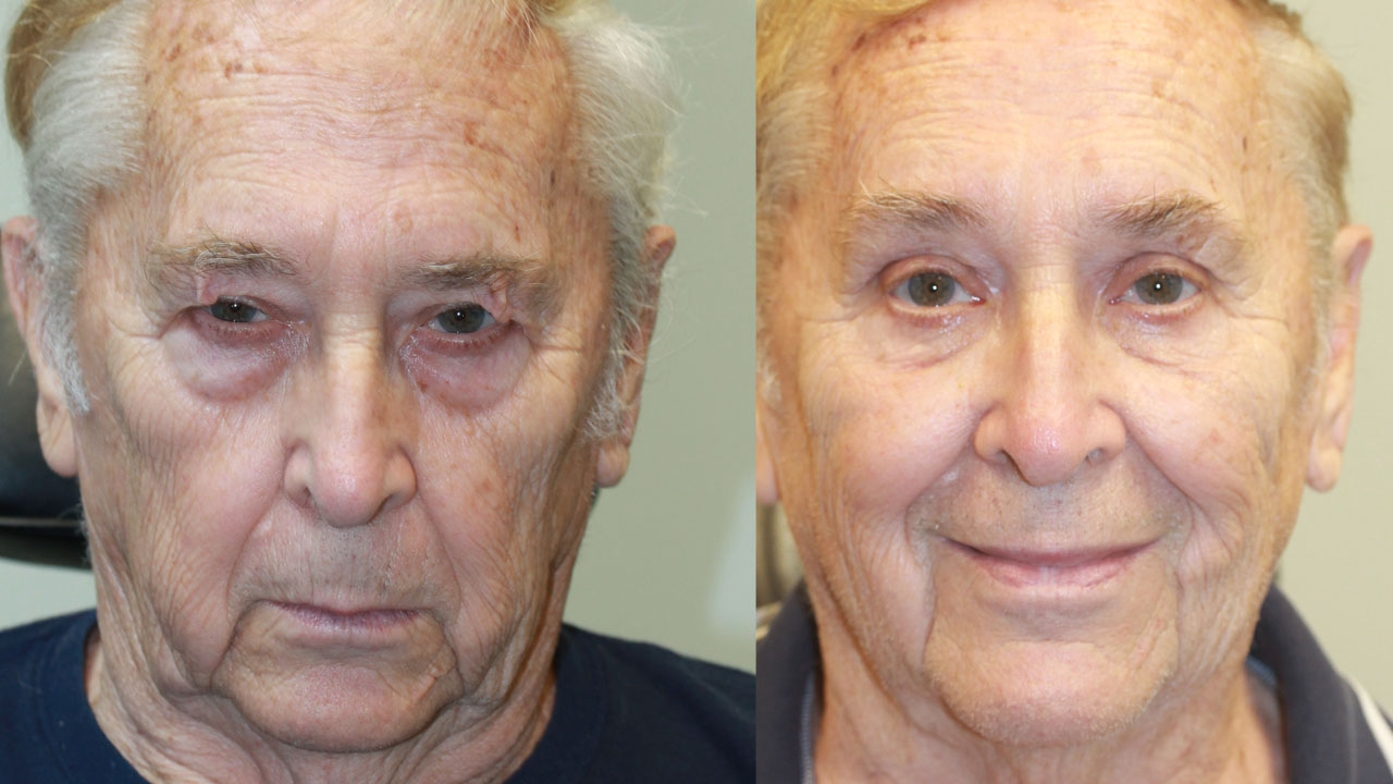 Blepharoplasty with AP & Fat Transfer